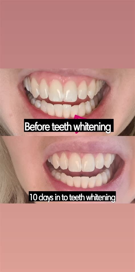 Teeth whitening reddit. Things To Know About Teeth whitening reddit. 